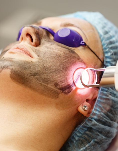 Laser Treatment